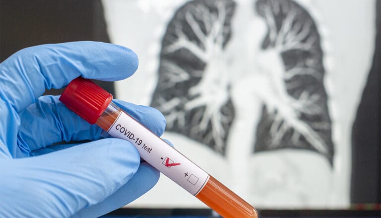Coronavirus diagnosed x-ray cat tomography, CT scan, negative blood test for Coronavirus